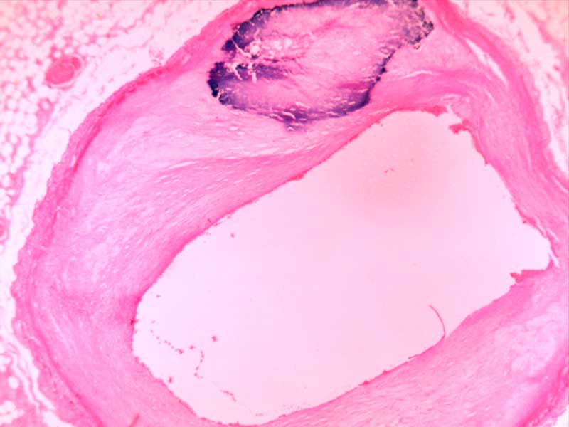 动脉粥样硬化-冠状动脉