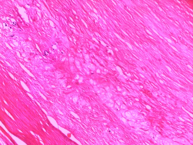 主动脉粥样硬化-10倍