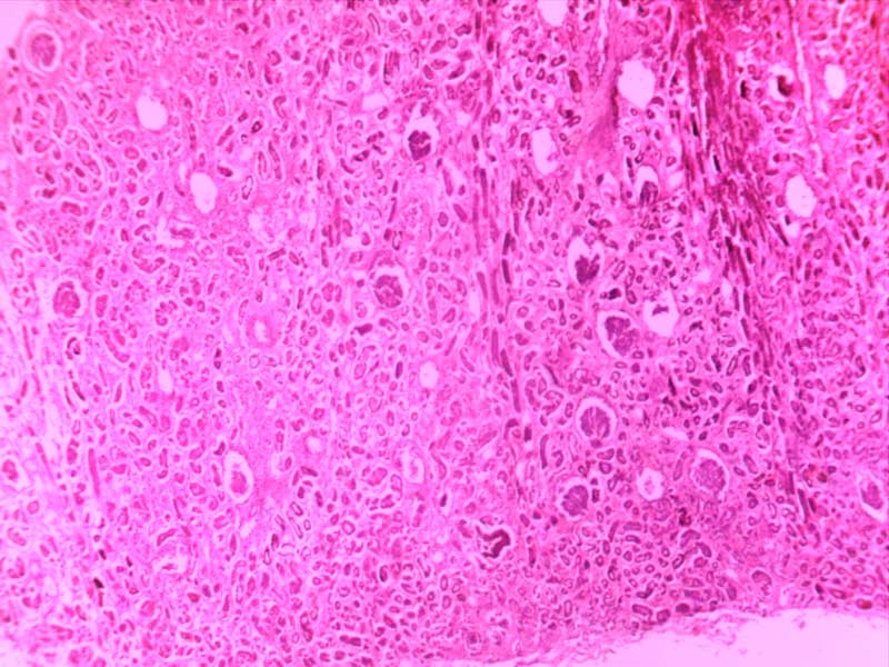 快速进行性肾小球肾炎-4倍