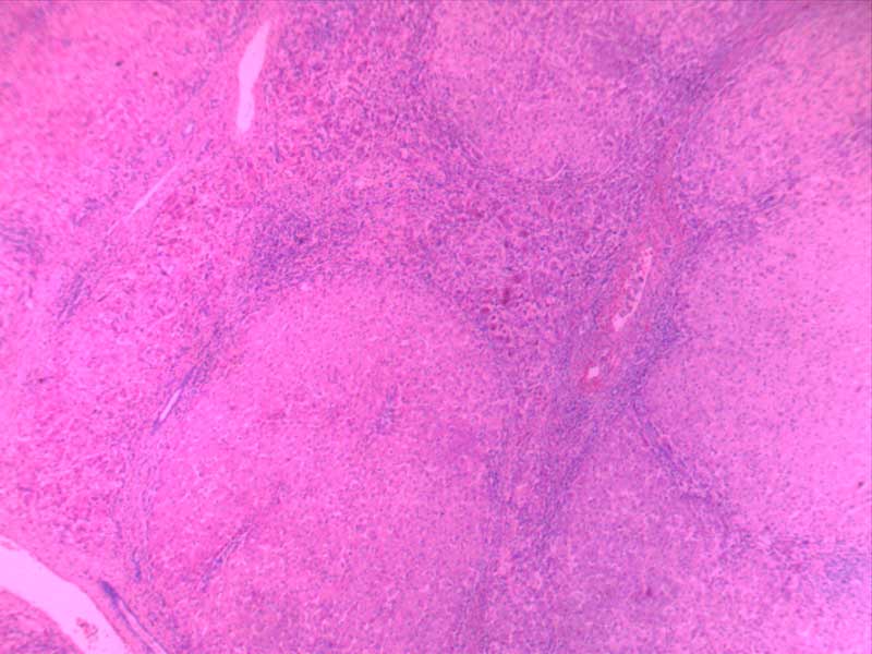 门脉性肝硬化-4倍