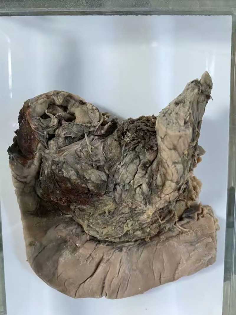 人体病理标本