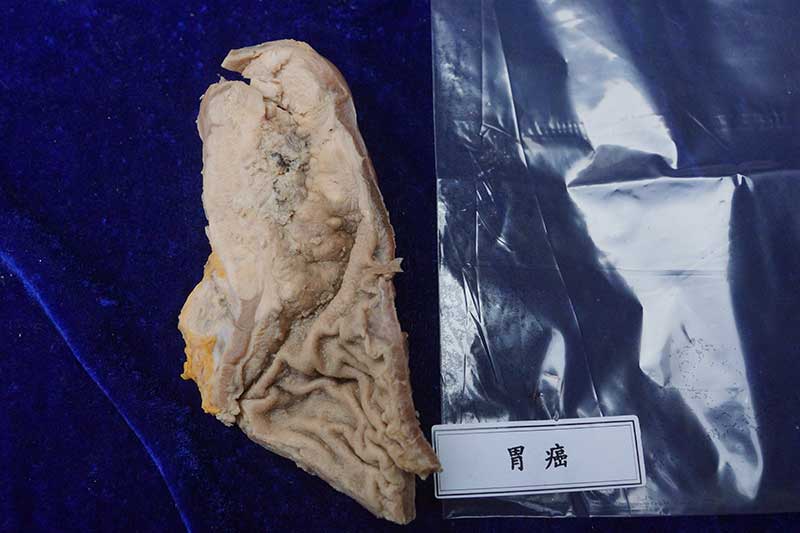 人体病理标本