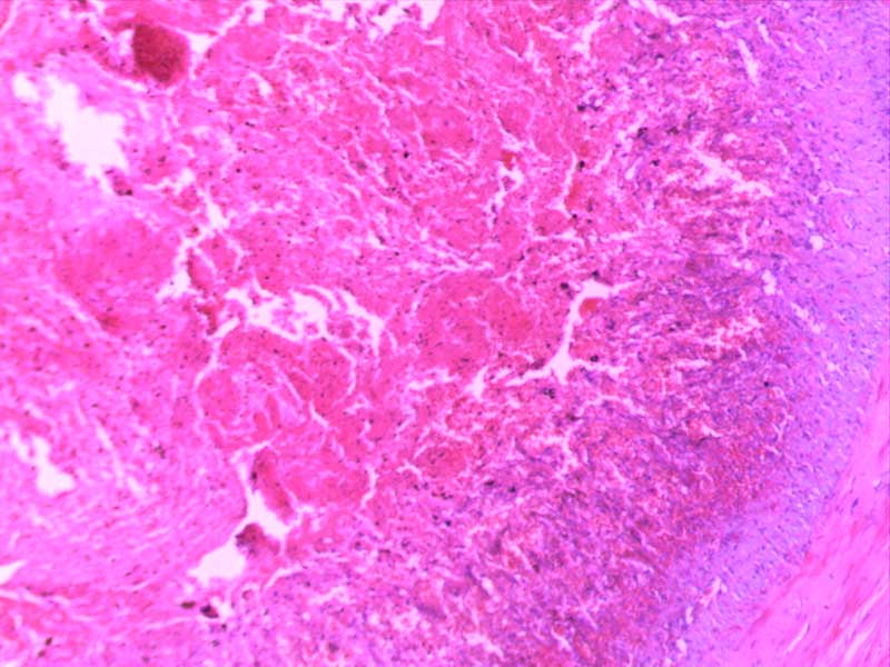 混合血栓-10倍-(3)