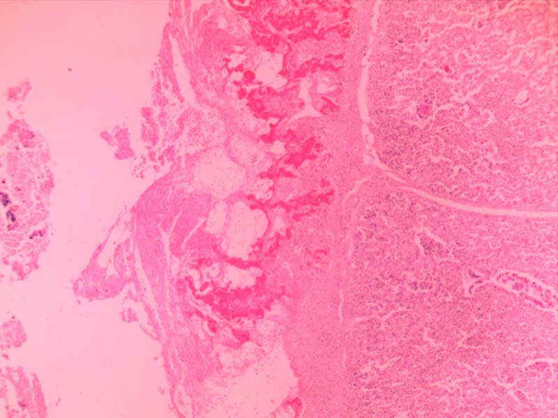 纤维素性胸膜炎