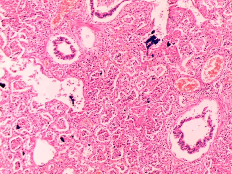 大叶性肺炎（红肝期）10倍