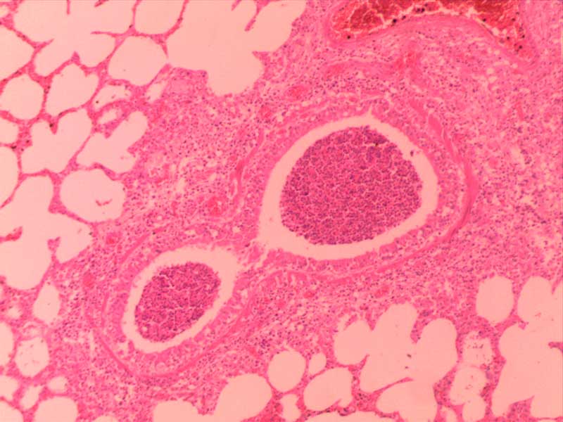 小叶性肺炎-10倍-(2)