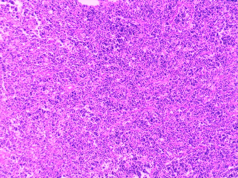 非霍奇金淋巴瘤