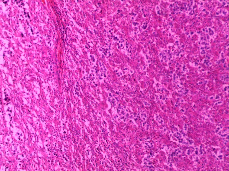 睾丸精原细胞瘤10倍