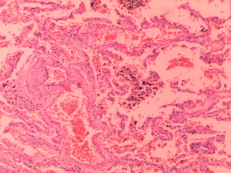 慢性肺淤血-10倍