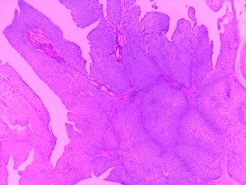 乳头状瘤（膀胱）4倍