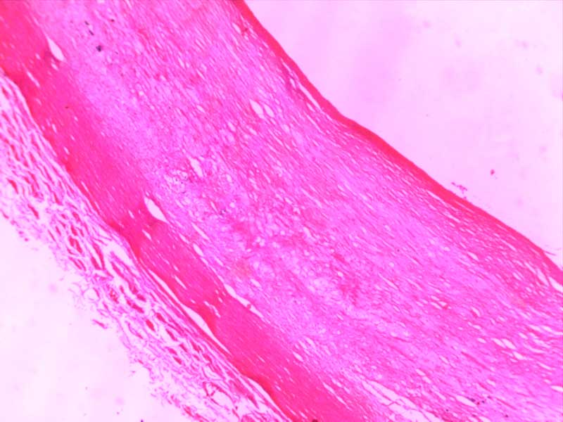 主动脉粥样硬化-4倍