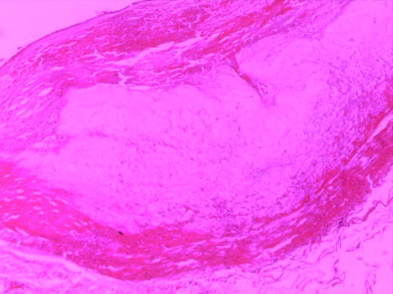 冠状动脉粥样硬化-4倍