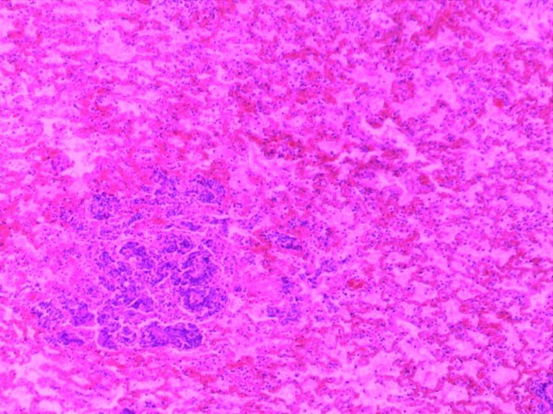 大叶性肺炎（红肝期）-10倍