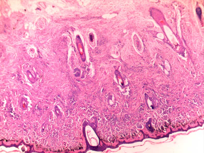 恶性黑色素瘤--皮肤