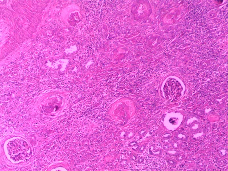 快速进行性肾小球肾炎-10倍