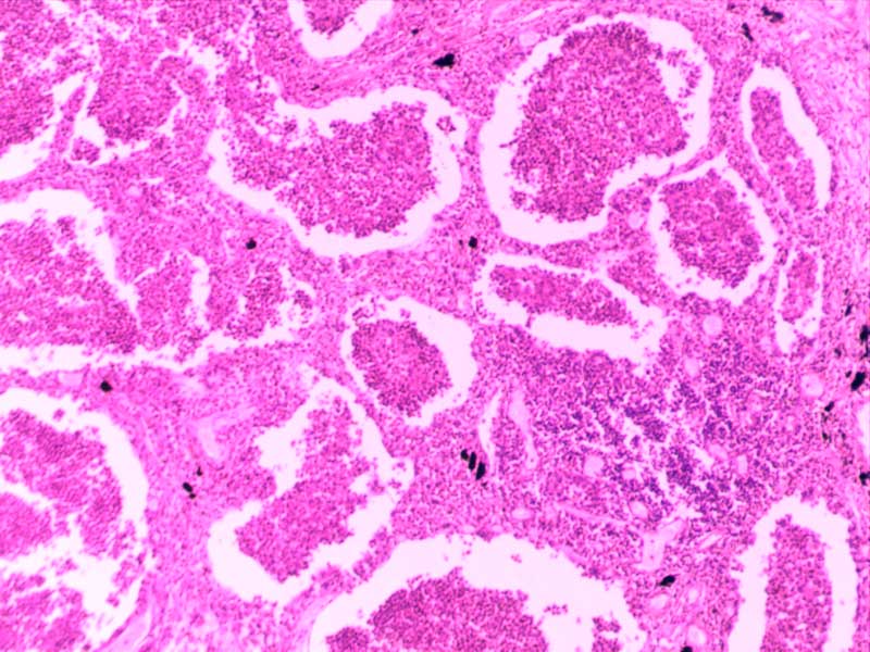 大叶性肺炎（灰肝期）-10倍