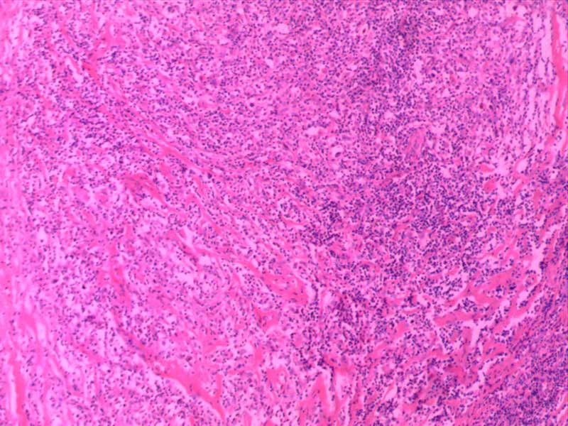 何杰金淋巴瘤10倍