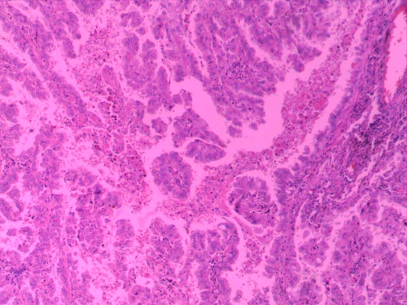 肺腺癌-10倍高分化