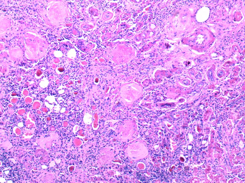 弥漫性硬化性肾小球肾炎
