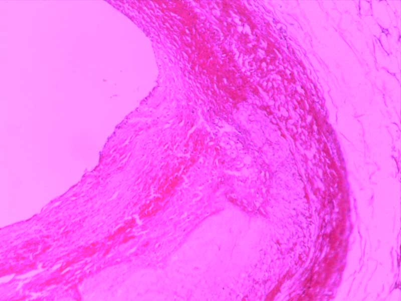 冠状动脉粥样硬化-10倍