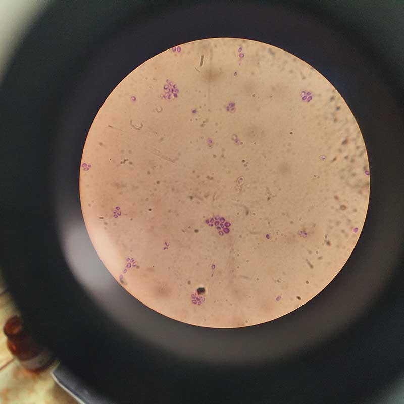 白色念珠菌涂片