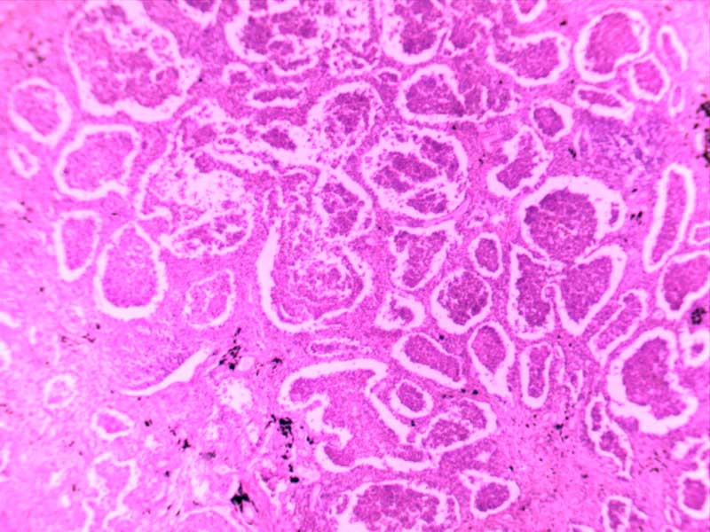 大叶性肺炎（灰肝期）-4倍
