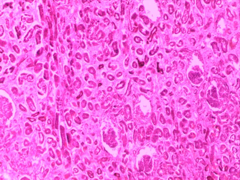 快速进行性肾小球肾炎-10倍