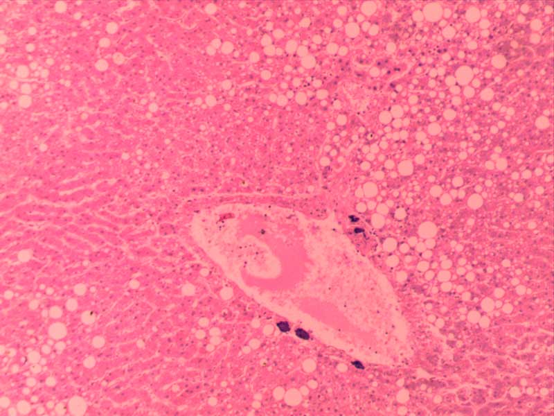 肝脂肪变性-10倍