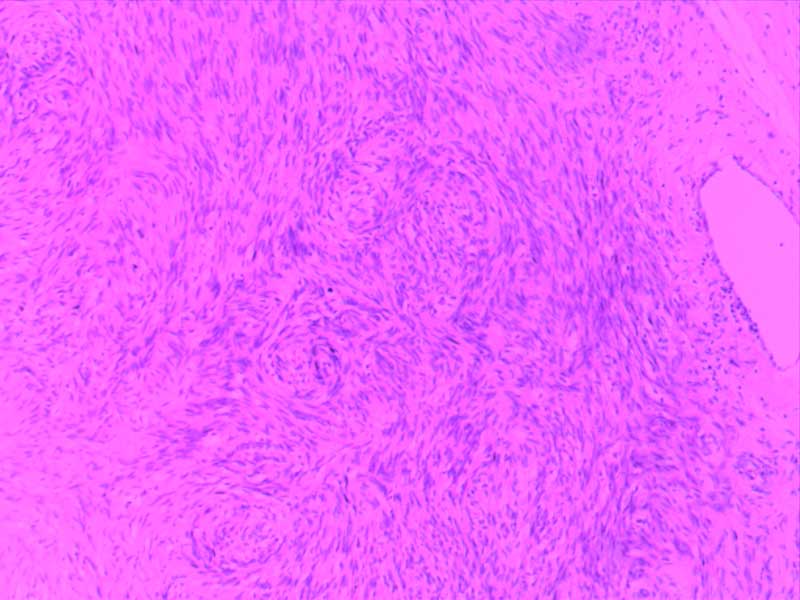 神经鞘瘤-10倍-(2)