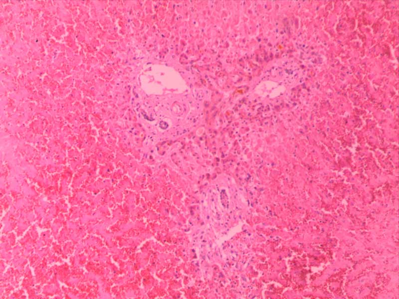 慢性肝淤血-10倍-(4)