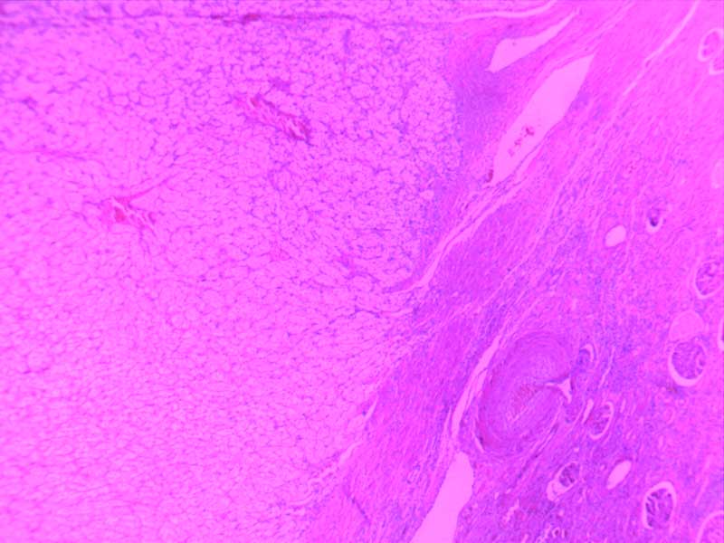 肾透明细胞癌-10倍